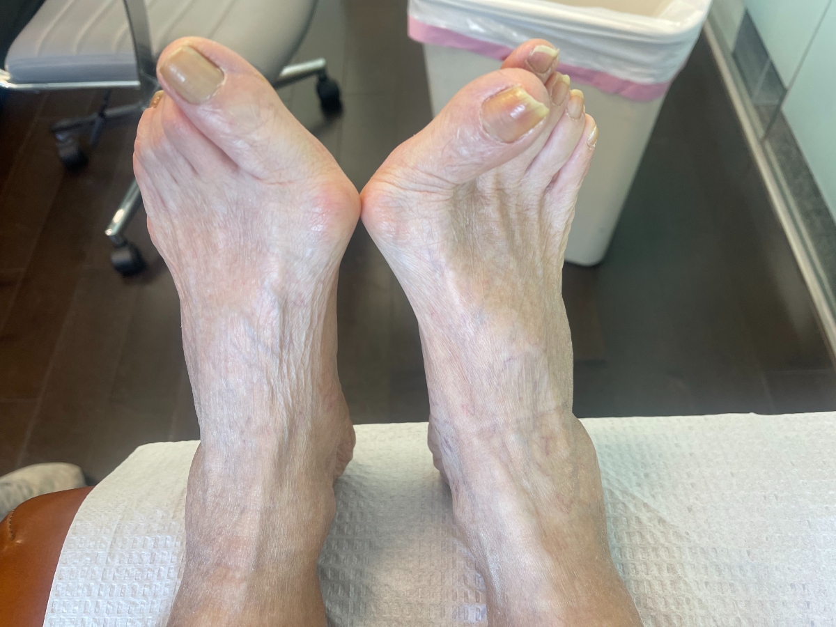 Bunions