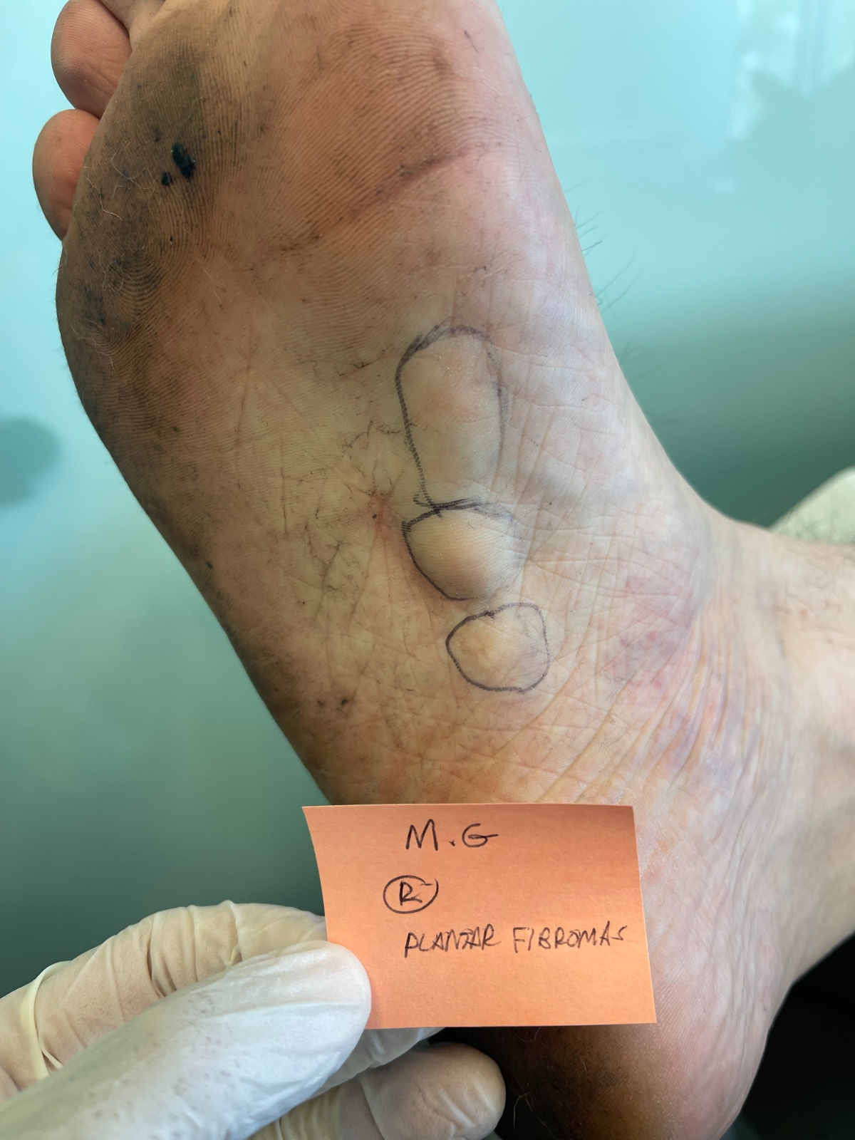 Plantar Fasciitis
